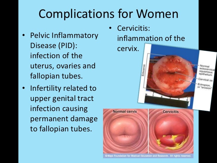 chlamydia mouth to penis Chlamydia mouth to penis